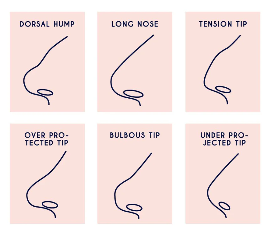 Rhinoplasty for the Bulbous Nose Treatment and Benefits