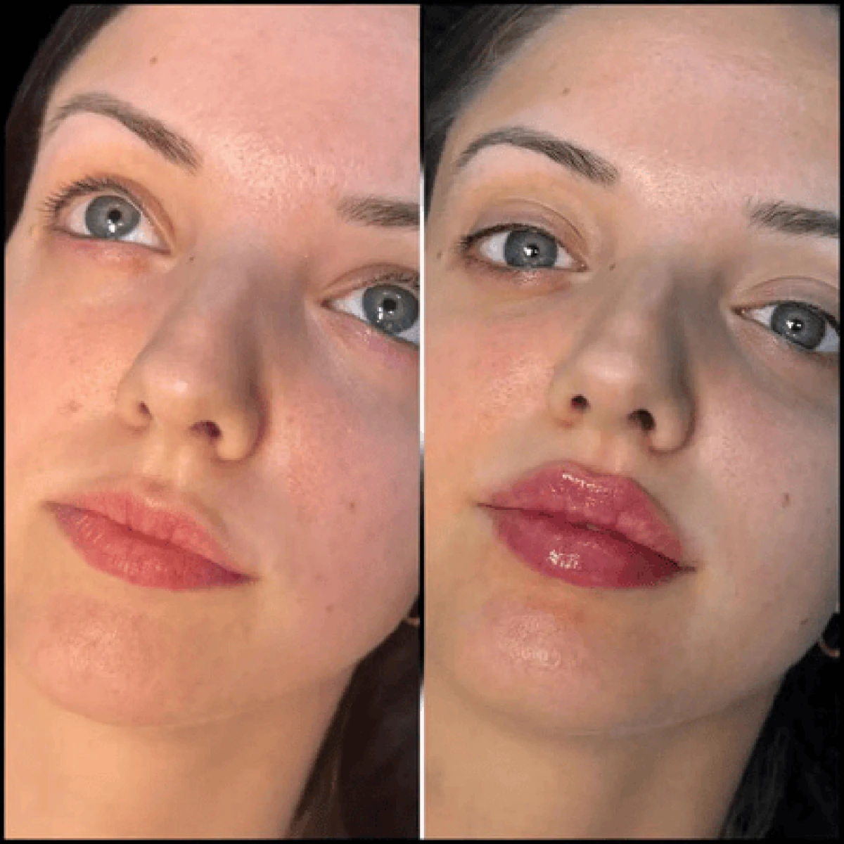 Best Plastic Surgeons in dubai for Personalized Fillers Procedures