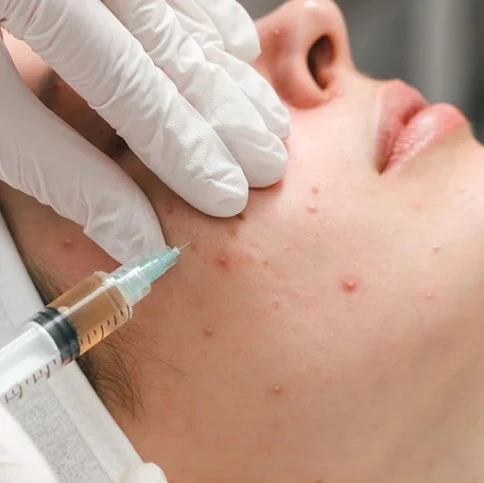 Acne Treatment In Dubai: Advanced Solutions for Clearer-Looking Skin