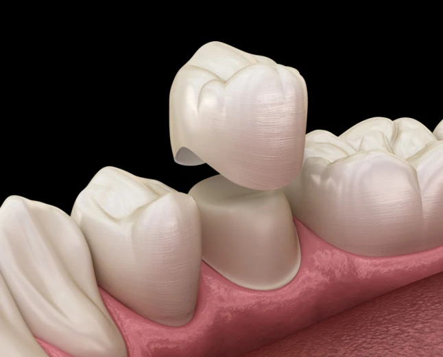 What Should You Do If Your Dental Crown Becomes Damaged?