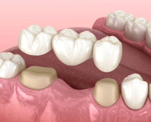 How Does a Dental Bridge Affect the Teeth Used to Support It?