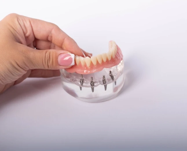 How Do Implant-Supported Dentures Stay Secure Without Adhesives?