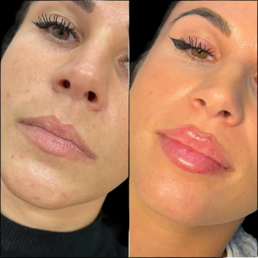Fillers Treatments in Dubai for Beautiful and Lasting Confidence